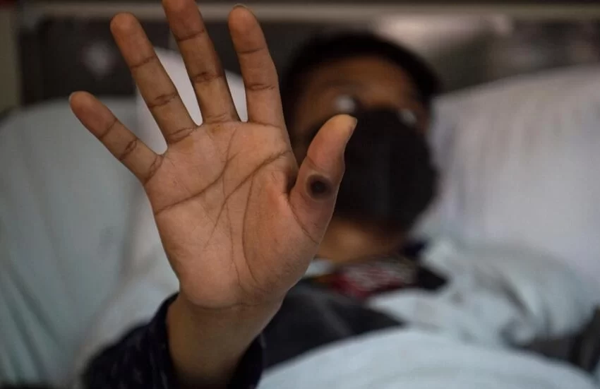  La OMS levanta la alerta máxima mundial por la epidemia de Mpox